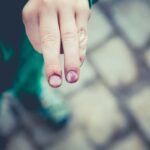 Memar: Tanda Kecil yang Punya Cerita Besar di Balik Kulit